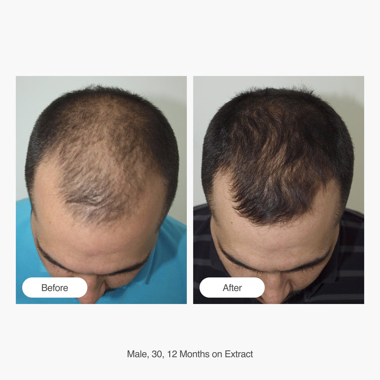 Hair Gain Extract